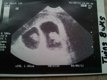 determining sex of the baby