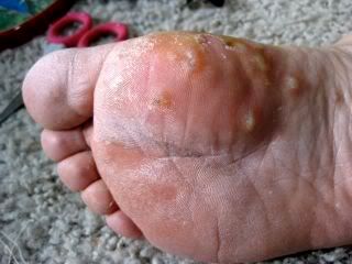 Small Foot Blister