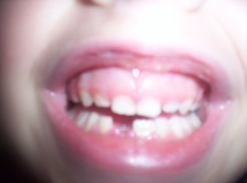 another loose tooth has fallen out!
